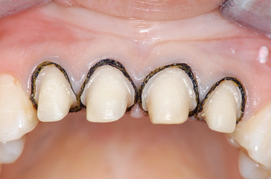 Atraumatic Tissue Management for a Perfect Impression